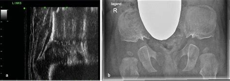 Achondroplasie: kinderorthopädische Betreuung im Wachstumsalter ...