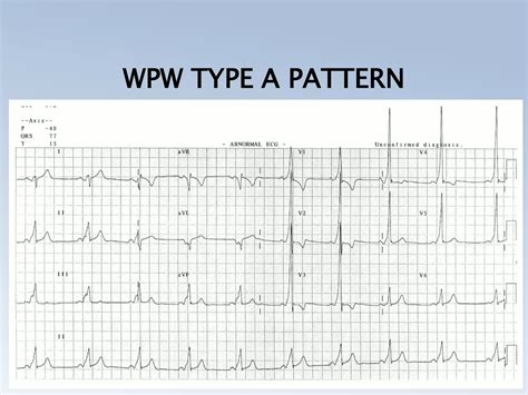 PRE EXCITATION SYNDROMES (THE WOLFF PARKINSON WHITE, LPL, MAHAIM) | PPTX