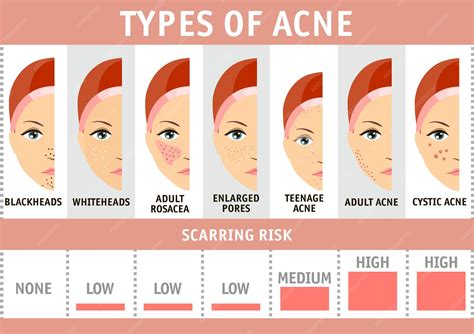 Premium Vector | Types of acne infographics vector illustration types of acne pimples skin pores ...