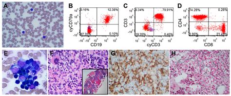 Hemophagocytic Lymphohistiocytosis with Predominant T-Lymphocytes in ...
