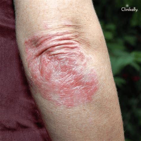 Psoriasis Treatments 101: Alternatives to OTC Treatments | Clinikally