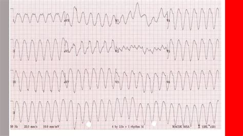 Ventricular Tachycardia Vs Ventricular Fibrillation Ventricular