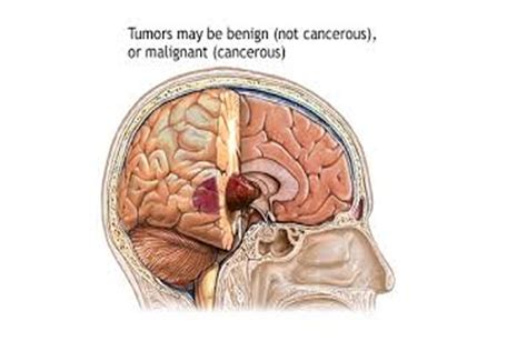 Brain Tumor Surgery in Delhi NCR - Dr. Kaviraj Kaushik