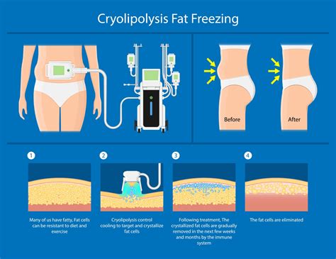 Does Freezing The Fat Work? An Honest Look At Cryolipolysis