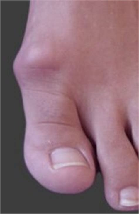 Footlab+ | 1st MTP joint (big toe) arthritis – Hallux Rigidus