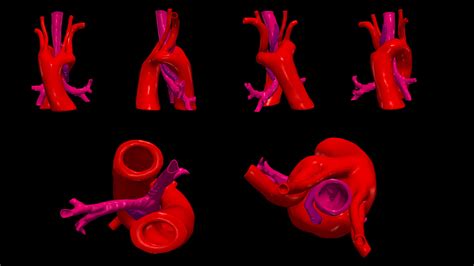 STL file 3D Model of Double Aortic Arch・3D printing template to download・Cults