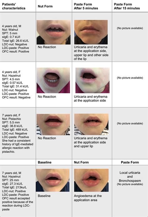 Lip Allergy Causes at Lisa Cunningham blog