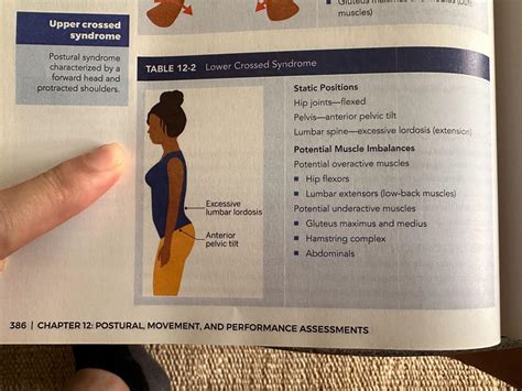 Lower Crossed Syndrome: Complete Guide (2025)