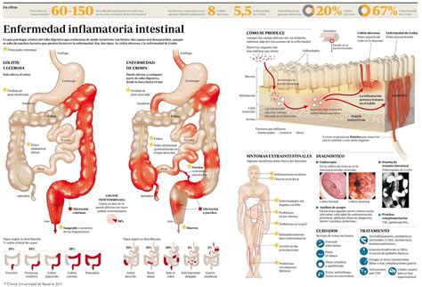 Enfermedad Inflamatoria Intestinal