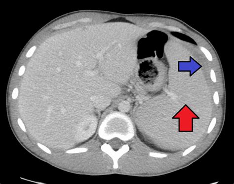 Infectious mononucleosis - Wikipedia