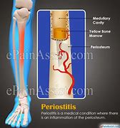 Image result for periproctitis