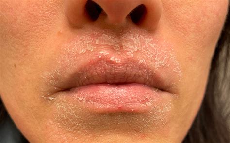 Perioral Dermatitis: Symptoms, Causes, Treatments & Prevention – Vedix