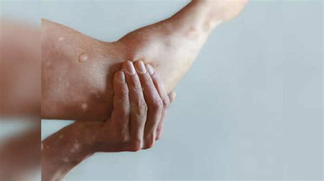 Monkeypox: Famous TikToker reveals monkeypox symptoms that appear at night