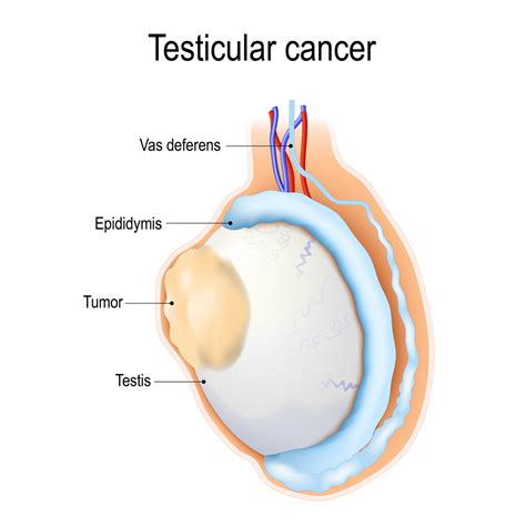 Testicular cancer - Care at Mayo Clinic - Mayo Clinic