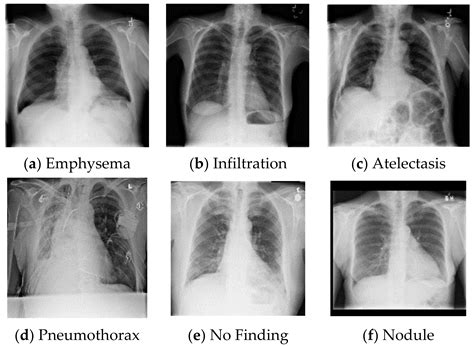 Normal Chest Xray Labeled