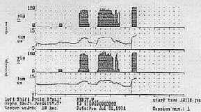 ANDROLOGY :Peyronie's Disease,curves/bends/lumps in the Penis,penile ...