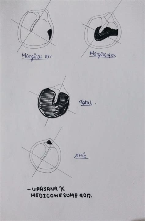 Medicowesome: Types of tympanic membrane perforation