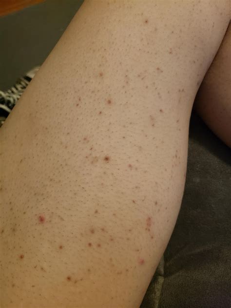 Razor Bumps On Legs Wont Go Away
