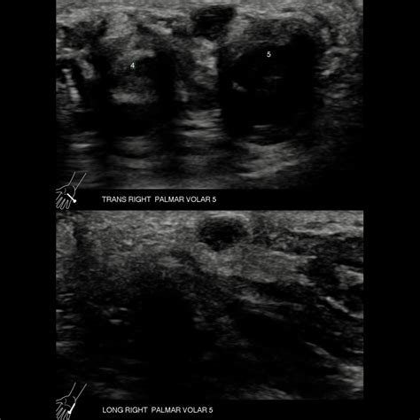 Pediatric Ganglion Cyst / Synovial Cyst | Pediatric Radiology Reference Article | Pediatric ...
