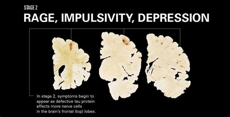 CTE Brain 的图像结果