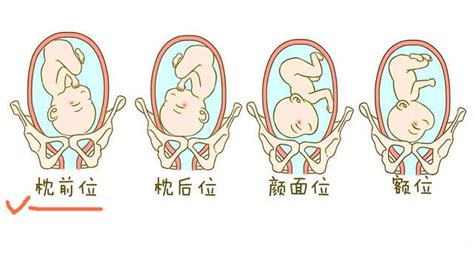 “胎位不正分娩导致婴儿头身分离”！关于“胎位”，孕妈们先不慌_宝宝