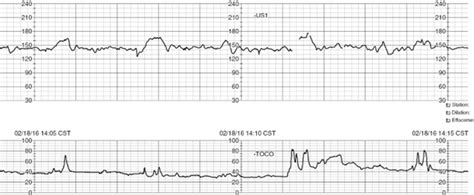 SIGNIFICANCE OF A SINUSOIDAL FETAL HEART RATE (FHR) PATTERN - Barber ...