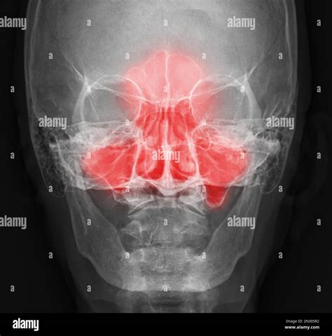 x-ray image of paranasal sinuses for diagnosis sinusitis Stock Photo ...
