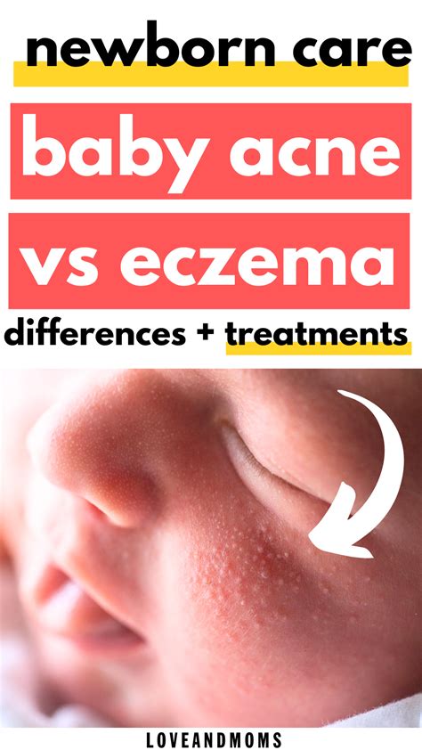 Baby eczema vs acne how to tell the difference – Artofit