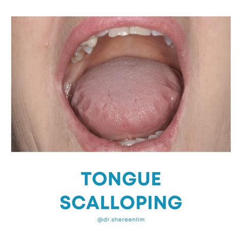 Tongue Scalloping | Dr Shereen Lim