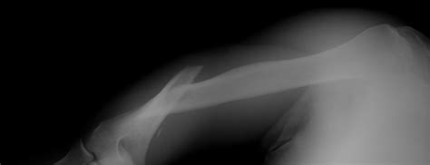 Orthopedic Trauma Fellowship — Teletype