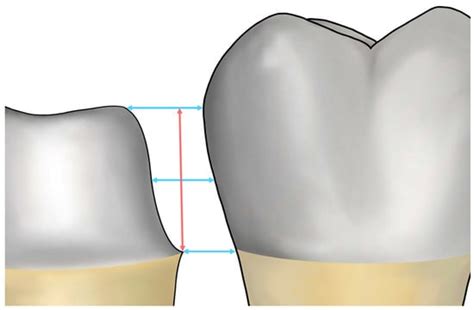 Effect of the Inter-Tooth Distance and Proximal Axial Wall Height of ...