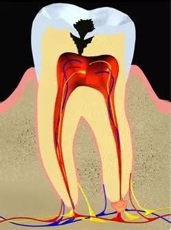 面对牙髓炎我们应该怎么做？_牙髓炎-深圳爱康健口腔医院