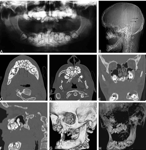 Osseous Abnormality Knee With Multiple Abnormalities On MRI Indicating