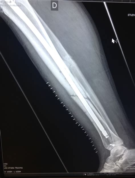 Management of a complex tib-fib fracture after delayed union - any ...