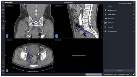 Stereotactic Navigation-Assisted Laparoscopic Resection of Challenging ...