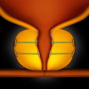 Image result for Problems After UroLift