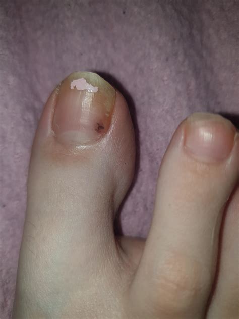 Toenail Melanoma Images at Carolyn Bey blog