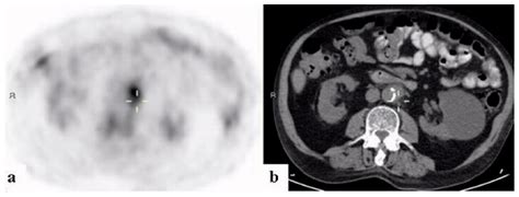 The Utility of 18FDG-PET/CT in Diagnosing Fever of Unknown Origin: The ...