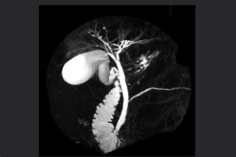 Image result for Abnormal MRCP