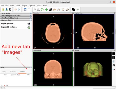 InVesalius Tutorial 的图像结果
