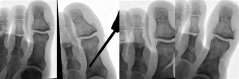 Minimalinvasive Vorfußchirurgie: Was ist das? - Orthopädie ...