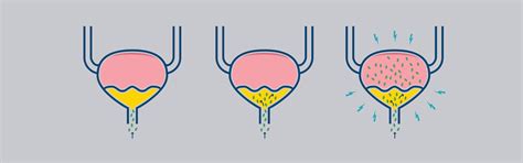 Urinary tract infection in men — UTI