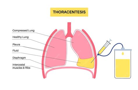 Premium Vector | Thoracentesis medical procedure