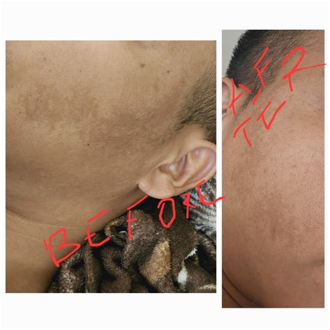 Dr. Sheth's Ashwagandha & Alpha Arbutin Melasma Serum Cream- 30G |For ...