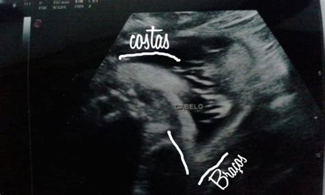 CABELO DO MEU BEBE NO ULTRASSOM..POSTEI FOTO PRA VCS VEREM ...