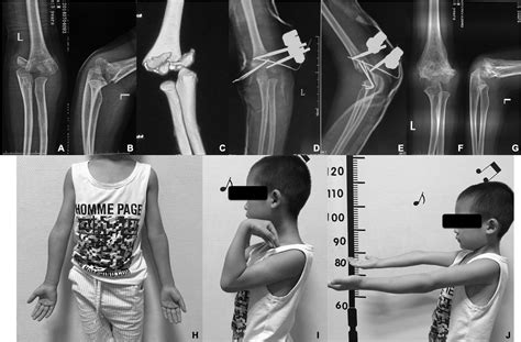 Distal Humerus Fracture Children