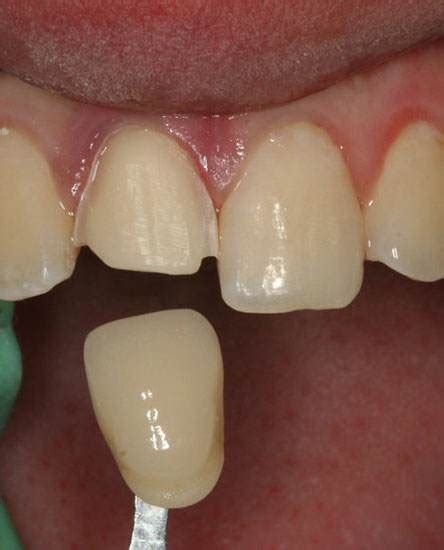 跪求被磨小的牙齿修复跪求老祖宗好好做人2022已更新今日推荐