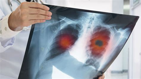 Image result for Thoracotomy Recovery