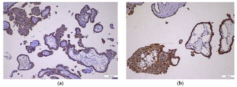 Hydatidiform Moles: The Contribution of Ancillary Techniques in ...