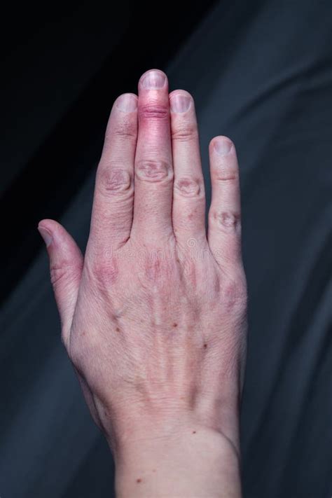 Splint Removal 的图像结果